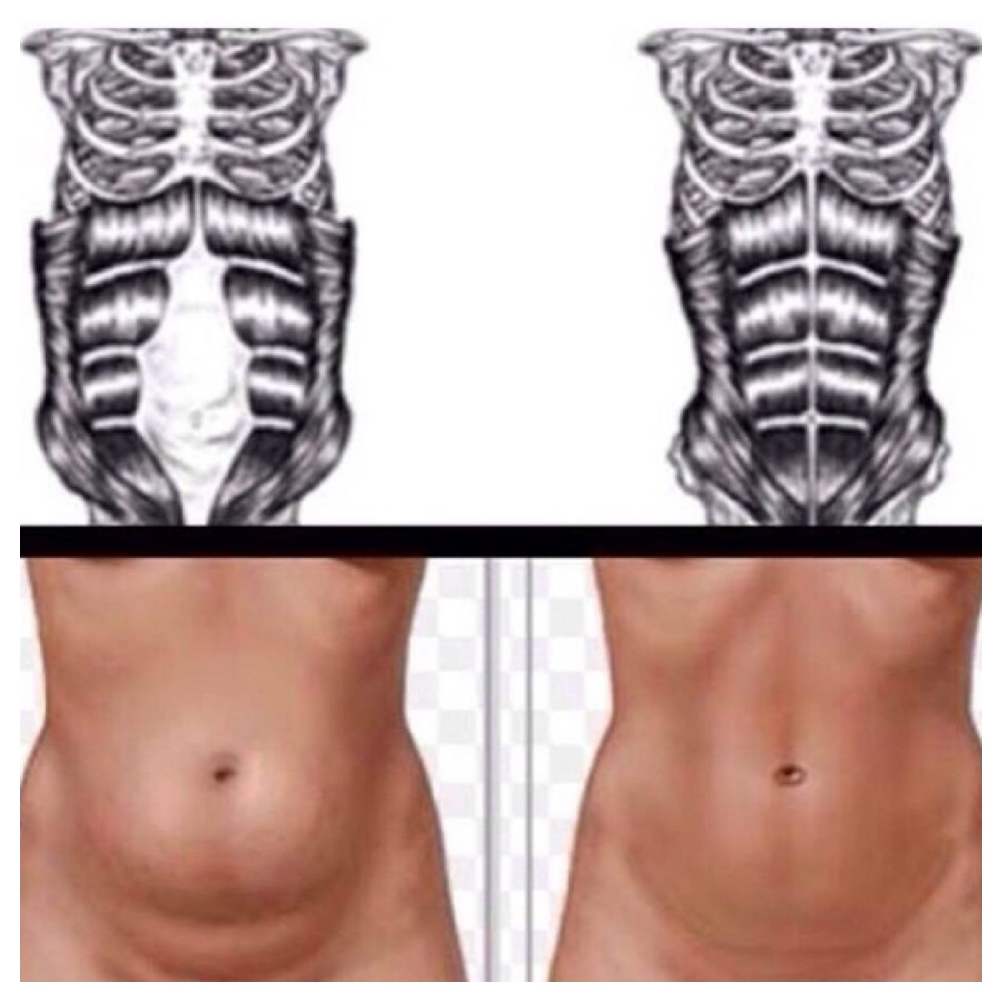 Baby fat or Diastasis Recti: Who is the Real Culprit? - Fitness 1 Gym